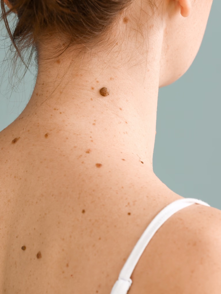 Woman with moles on skin, early skin cancer detection at Montrose London